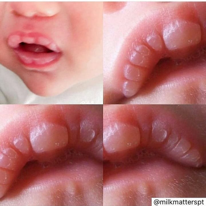 Whiteish bumps on your babys precious lips after a feed?